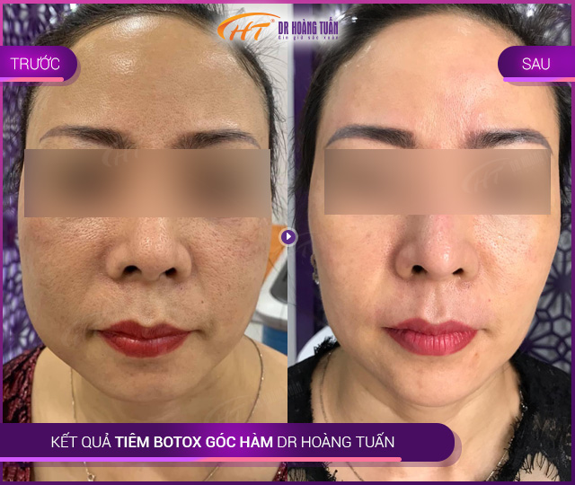 Kết quả dùng botox góc hàm tại Thẩm mỹ Hoàng Tuấn